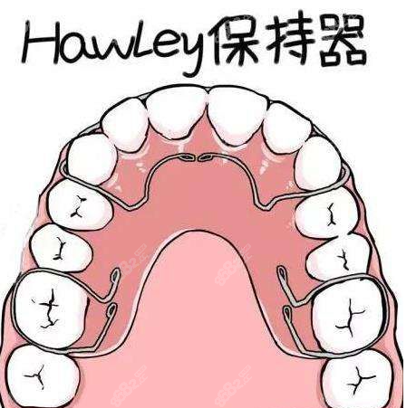 大盘点哈利式hawleys保持器和透明隐形保持器的优缺点