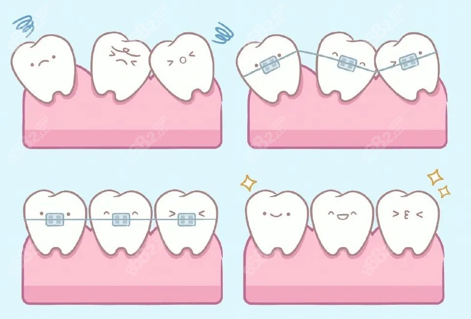 湖州吴兴区牙齿矫正多少钱时代天使隐形矫正费用也说下吧