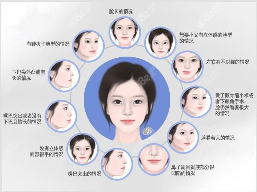 国内外正颌双鄂手术可以改善的脸型